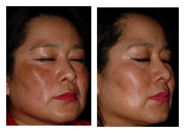 niacinamide before and after