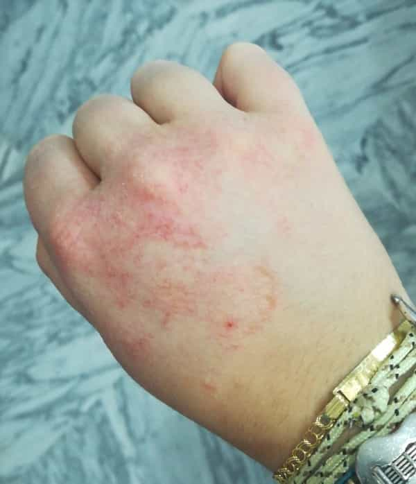 Eczema