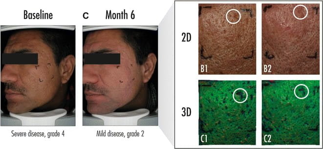 adapalene scars results