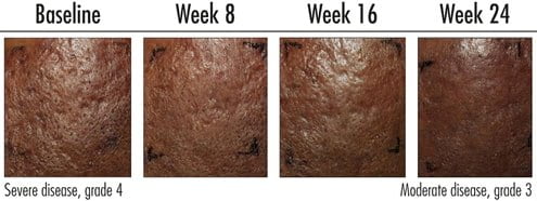 Adapalene acne scars weekly progress